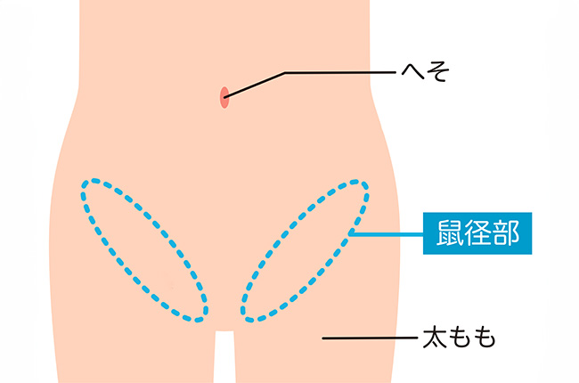 そけいヘルニアは意外と身近な病気です